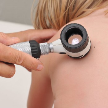 Câncer de pele nas crianças. Como reconhecer um melanoma