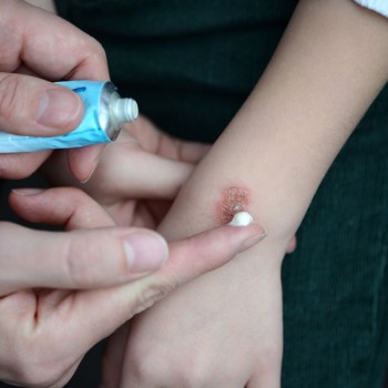 Queimaduras. Primeiros socorros para crianças