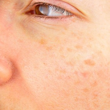 Manchas no rosto durante a gravidez