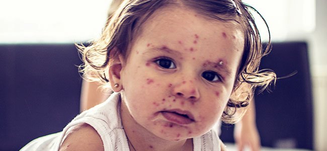 sarampo em crianças