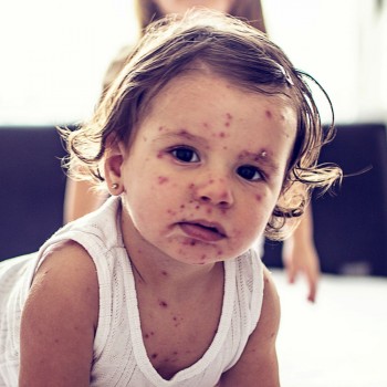 Crianças e bebês com Sarampo