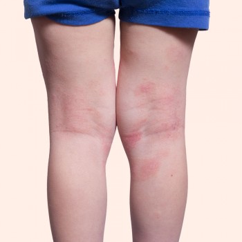 Decálogo para controlar a Dermatite Infantil