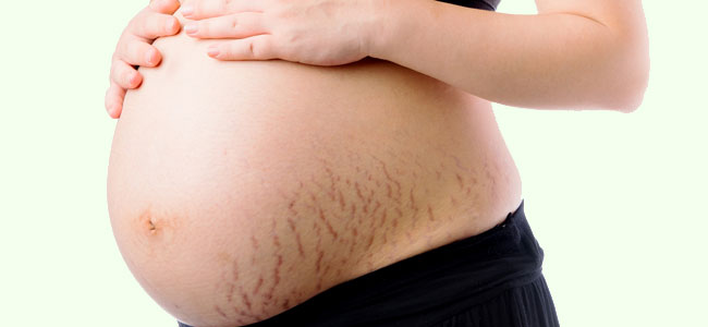 As estrias durante a gravidez