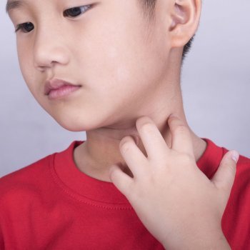 Como aliviar as coceiras provocadas pela dermatite infantil