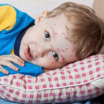 Atenção também com a varicela