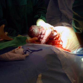 A cesárea supera a metade dos partos no Brasil