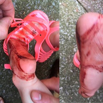 Sandálias de borracha: o calçado mais perigoso para as crianças