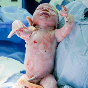 Riscos da semeadura vaginal no recém-nascido