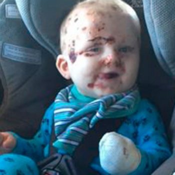 O que pode acontecer se você não vacinar o seu bebê contra a catapora