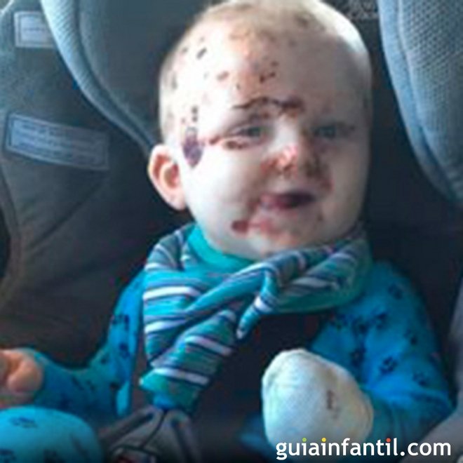 O que pode acontecer se você não vacinar o seu bebê contra a catapora