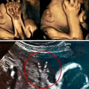 Gestos curiosos de bebês no ventre materno