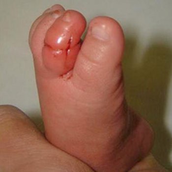 O perigo de estrangular o dedo do bebê