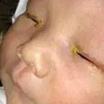 O risco de deixar cego a um bebê por usar o flash numa fotografia