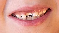 Acidentes e quebra de dentes na infância