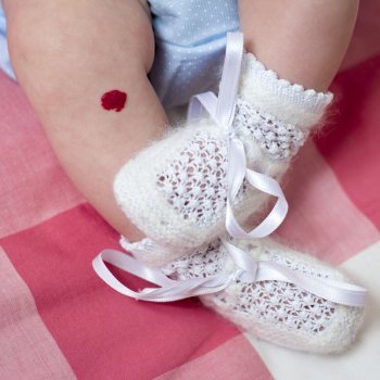 Manchas de nascença nos bebês. Tudo o que você deve saber