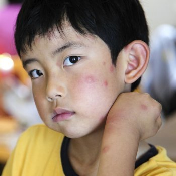 Como proteger as crianças da dengue