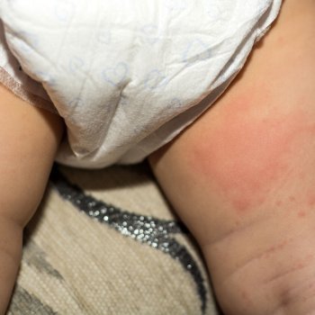 Bebês com Assaduras ou Eczemas