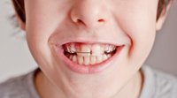 Por que algumas crianças têm os dentes separados
