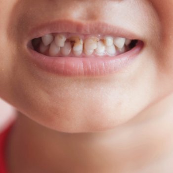 O que significa se a criança sonha que os seus dentes caem
