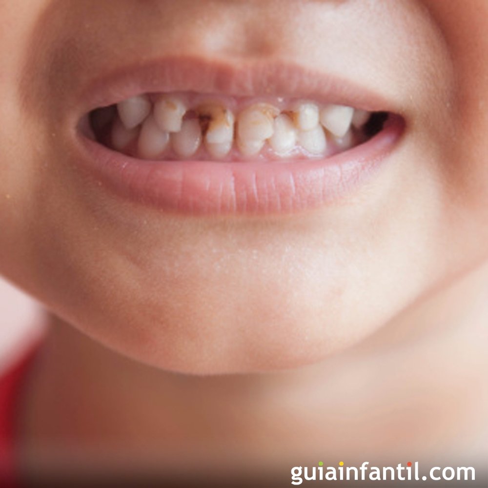 Featured image of post Sonhar Com Dente Quebrado Tais fraturas podem causar dor aguda al m de sujeitar o dente a infec es e a se deteriorar ainda