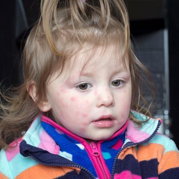 Molusco contagioso em bebês e crianças