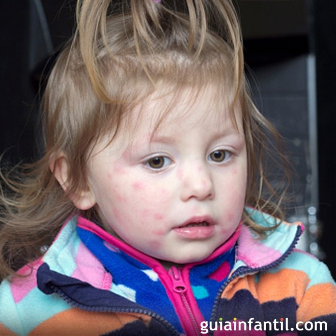 Molusco contagioso em bebês e crianças