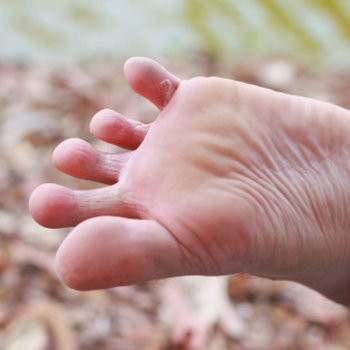 A micose: sintomas e formas de contágio