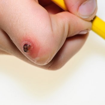 As verrugas em crianças. Causas e tratamento