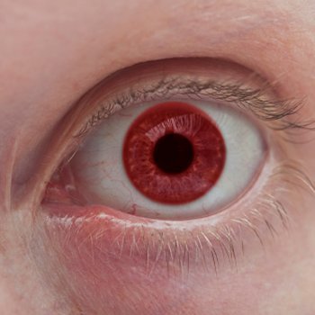 Crianças albinas. Albinismo na infância