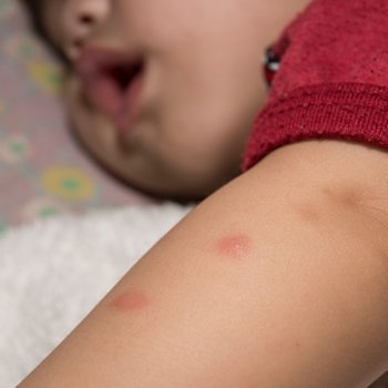 Zika vírus e as crianças