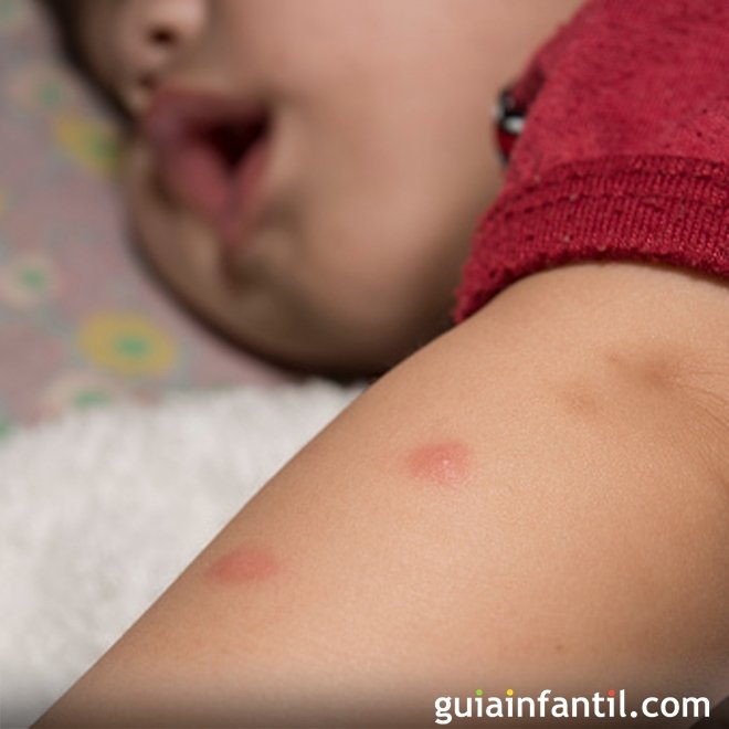 Zika vírus e as crianças