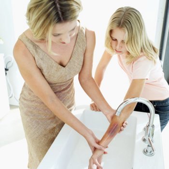 Lesões por queimaduras na pele da criança