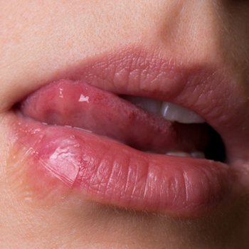 Herpes labial durante a gravidez