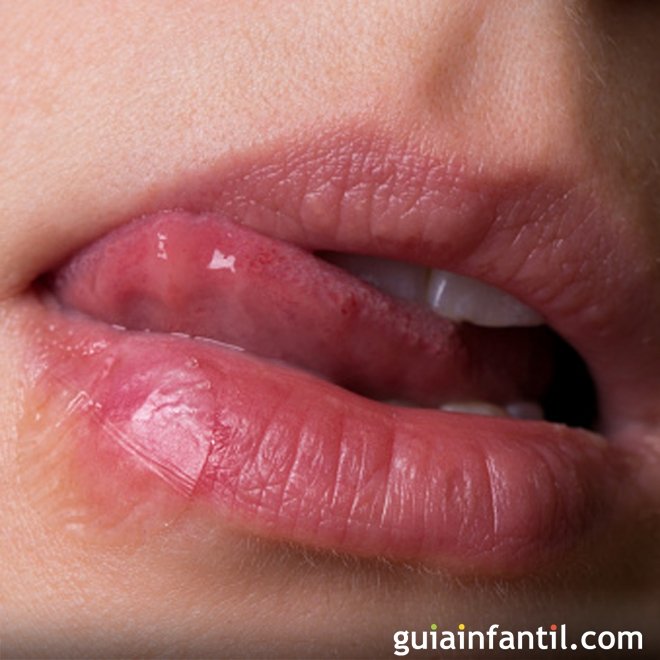 Herpes labial durante a gravidez