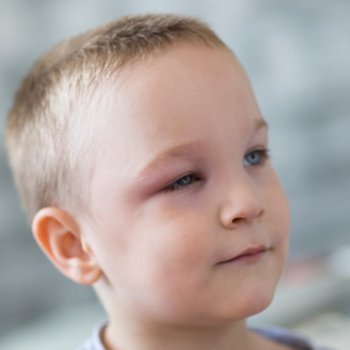 Remédios naturais contra o terçol em crianças