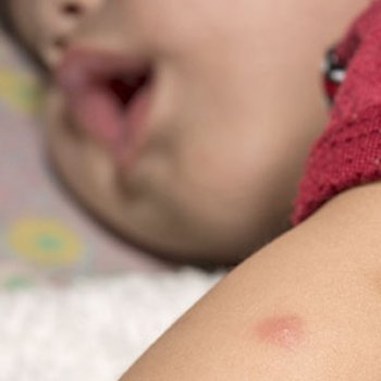 O perigo das picadas de carrapato em crianças