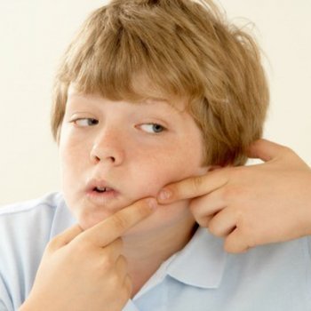 5 dicas para eliminar a acne nas crianças