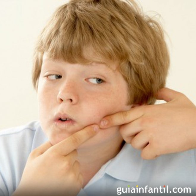 5 dicas para eliminar a acne nas crianças