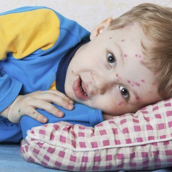 Bebês com Catapora ou Varicela. Doenças infantis