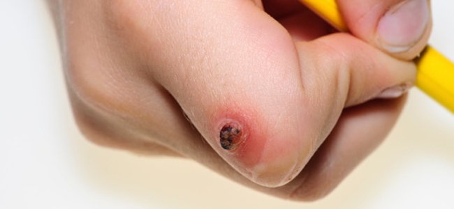 as-verrugas-em-crianças-causas-tratamento A as-verrugas-em-crianças-causas-tratamento A