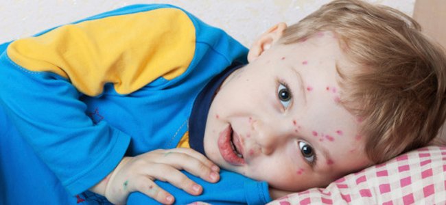 atenção-também-com-a-varicela A atenção-também-com-a-varicela A