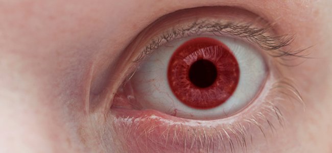 crianças-albinas-albinismo-infância A crianças-albinas-albinismo-infância A