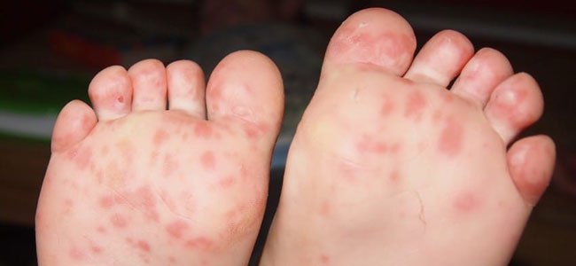 fotografias-para-reconhecer-o-vírus-mão-pé-boca-2 A fotografias-para-reconhecer-o-vírus-mão-pé-boca-2 A
