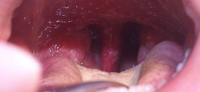 fotografias-para-reconhecer-o-vírus-mão-pé-boca-3 A fotografias-para-reconhecer-o-vírus-mão-pé-boca-3 A