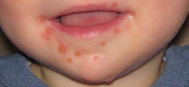 fotografias-para-reconhecer-o-vírus-mão-pé-boca A fotografias-para-reconhecer-o-vírus-mão-pé-boca A