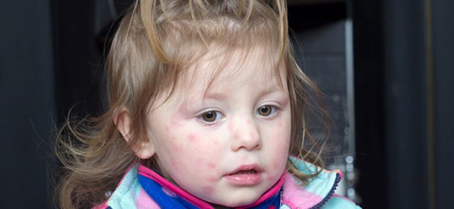 molusco-contagioso-em-crianças-bebês A