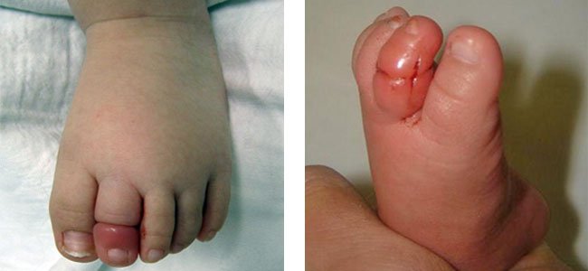 o-perigo-de-estrangular-o-dedo-bebê A o-perigo-de-estrangular-o-dedo-bebê A