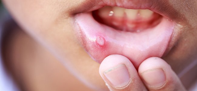 o-que-é-a-gengivoestomatite-inflamação A