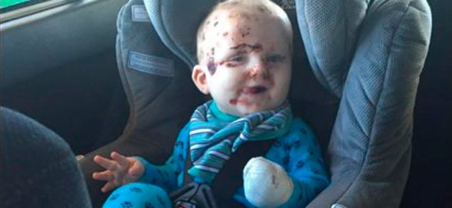 o-que-pode-acontecer-se-não vacinar-catapora 2 A