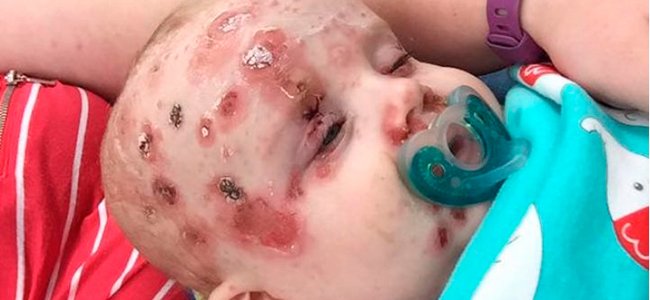 o-que-pode-acontecer-se-não vacinar-catapora A